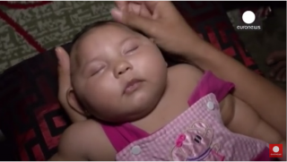  Une étude française établit le lien entre le virus Zika et le syndrome neurologique de